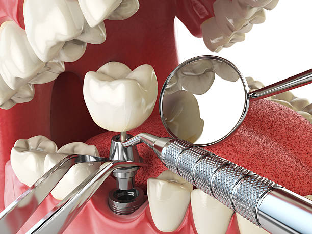 Best Emergency Root Canal Therapy in Mccullom Lake, IL